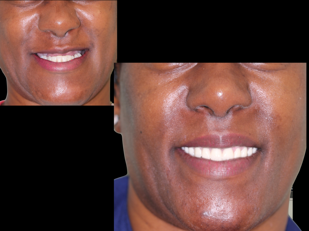 Azar Implant Dentistry | VELscope reg  Cancer Screening, Juvederm reg  and Implant Restorations