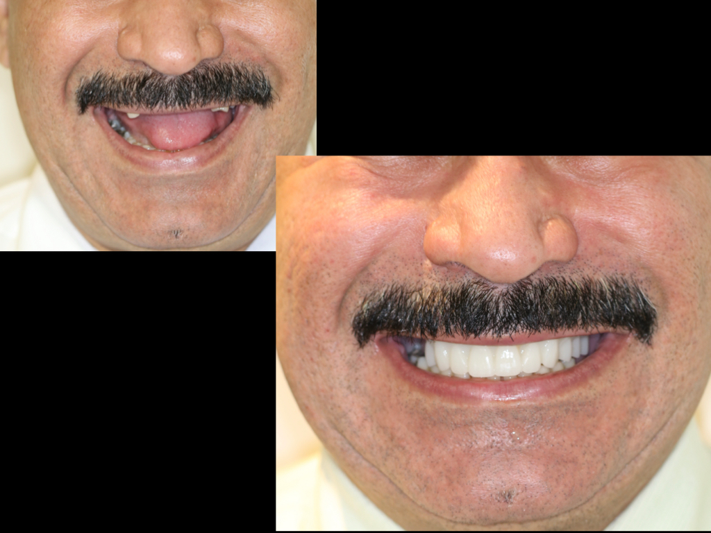 Azar Implant Dentistry | All-on-4 reg , Juvederm reg  and Implant Restorations